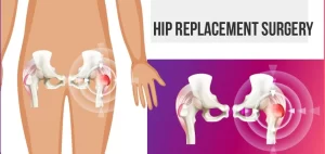 Hip replacement surgery